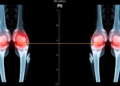 Ultrasound Stiffness Test Detects Knee Fat Pad Edema With Striking Accuracy