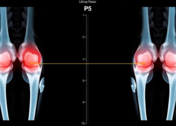Ultrasound Stiffness Test Detects Knee Fat Pad Edema With Striking Accuracy