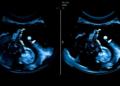 AI That Watches the Whole Scan: Deep Learning Reads Breast Ultrasound Videos Better Than Doctors