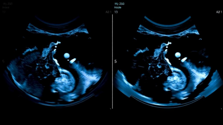 AI That Watches the Whole Scan: Deep Learning Reads Breast Ultrasound Videos Better Than Doctors