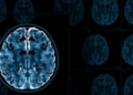 AI Spots the Earliest Whisper of Alzheimer's Disease in Routine Brain Scans