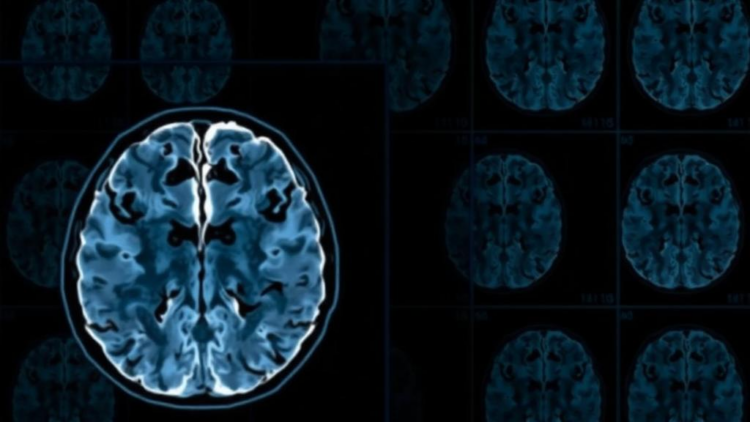 AI Spots the Earliest Whisper of Alzheimer's Disease in Routine Brain Scans