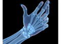 Simple Regression Models Bring Predictive Socket Design Closer for Transradial Prostheses