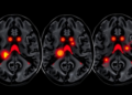 AI Reads Ultrasound Signals to Predict Which Carotid Plaques May Trigger Stroke