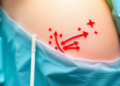 New Risk Model Flags Skin Damage Around PICC Lines Before It Strikes