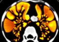AI Reads CT Scans to Predict Esophageal Cancer Response, With Mixed Results