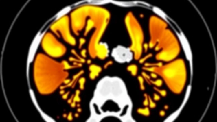 AI Reads CT Scans to Predict Esophageal Cancer Response, With Mixed Results