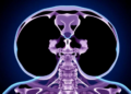 Weekly or Every-Three-Week Cisplatin? Trial Finds Similar Acute Toxicity Burden in p16-Negative Head and Neck Cancer