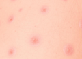 Who Counts? Single-Center Audit Probes Whether a National Psoriasis Registry Truly Reflects Real Patients