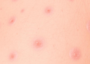 Who Counts? Single-Center Audit Probes Whether a National Psoriasis Registry Truly Reflects Real Patients