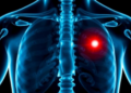 Simple Blood Test Clue Helps Predict Bone Metastasis in New Prostate Cancer Cases