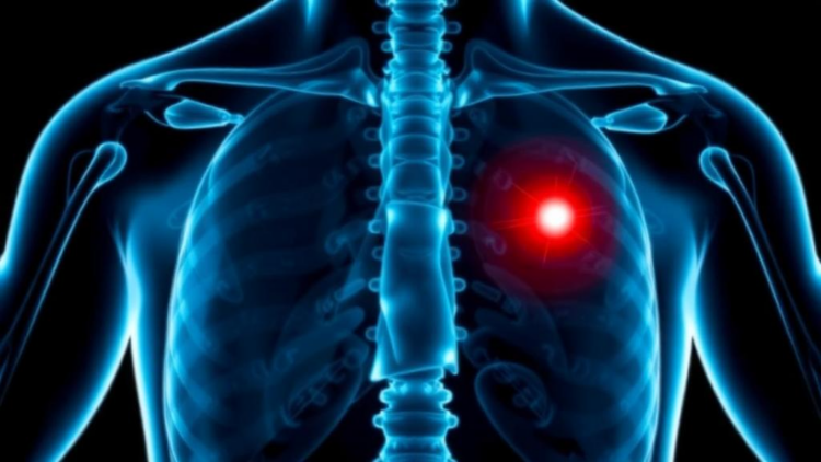 Simple Blood Test Clue Helps Predict Bone Metastasis in New Prostate Cancer Cases