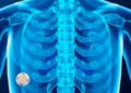 Switching HIV Drugs or Adding Zoledronic Acid Rebuilds Bone Lost to Tenofovir