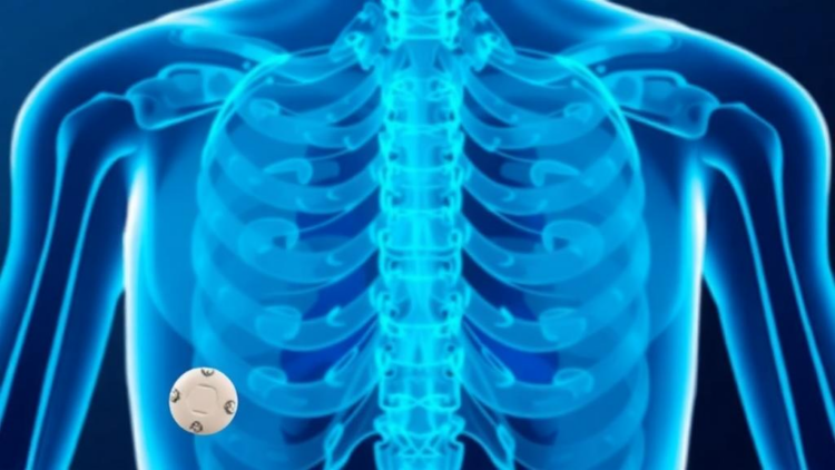 Switching HIV Drugs or Adding Zoledronic Acid Rebuilds Bone Lost to Tenofovir