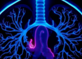CT Scans Match Catheter Measurements of Bleeding Lung Arteries, Study Finds