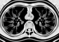 AI Reads Lymph Node CT Scans to Predict Nasopharyngeal Cancer Treatment Success