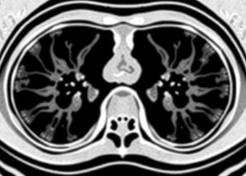 AI Reads Lymph Node CT Scans to Predict Nasopharyngeal Cancer Treatment Success