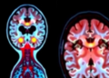 Brain Scans Reveal Hidden Clues to Gut Scarring in Crohn's Disease