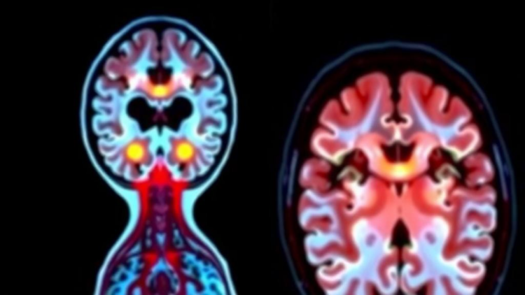 Brain Scans Reveal Hidden Clues to Gut Scarring in Crohn's Disease