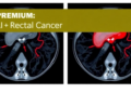 AI Reads Rectal Cancer MRI Scans to Spot Dangerous Blood Vessel Invasion