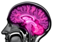Rare Facial-Onset Nerve Disease Reveals Its Brain Footprint in Advanced MRI Study