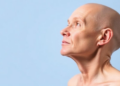 Why Head and Neck Cancer Rehab Trials Must Stratify for Lymphoedema