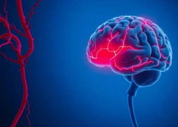 When Lupus Strikes the Brain's Veins: Rare Childhood Stroke Clue Emerges