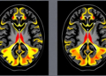 Rare Sarcoma Brain Metastases Show Striking Imaging Signatures on MRI Scans