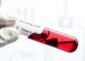 Blood Test for Tumor DNA Predicts Survival After Cancer Treatment Before Surgery