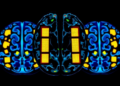 Radioactive Tiles Implanted During Surgery Halve Recurrence Risk in Brain Metastases Trial