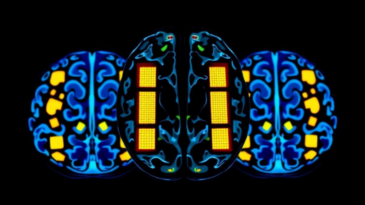 Radioactive Tiles Implanted During Surgery Halve Recurrence Risk in Brain Metastases Trial