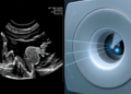 Ultrasound Meets Cone-Beam CT: Phantom Test Hits Millimeter Precision for Spine Surgery Navigation