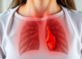 Pooled sputum testing halves TB diagnosis costs, reaching the missed millions