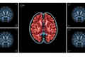 Splitting Radiation Into Multiple Sessions Cuts Recurrence and May Extend Survival After Brain Metastasis Surgery