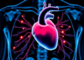 Fat Around the Heart Grows Larger and Denser in Psoriasis, CT Study Finds