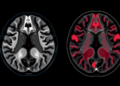 AI Reads MRI Scans to Tell Apart Two Breast Cancer Subtypes Without a Biopsy
