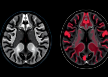 AI Reads MRI Scans to Tell Apart Two Breast Cancer Subtypes Without a Biopsy