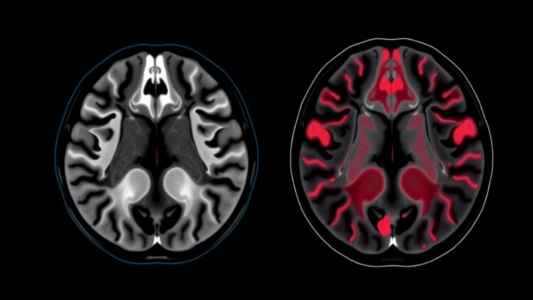 AI Reads MRI Scans to Tell Apart Two Breast Cancer Subtypes Without a Biopsy