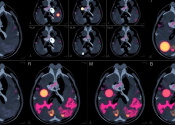 MRI Scans Reveal Hidden Cell Neighborhoods That May Signal Breast Cancer Spread