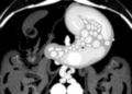 AI Reads Routine CT Scans to Predict Gastric Cancer Biomarker Without Biopsy