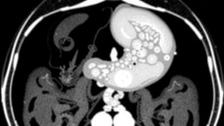 AI Reads Routine CT Scans to Predict Gastric Cancer Biomarker Without Biopsy