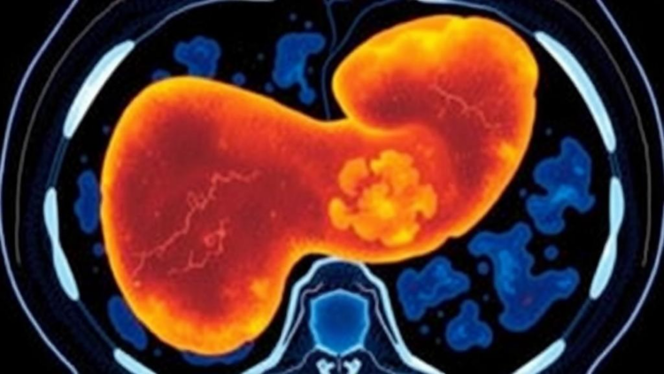 Fatty Pancreas on CT Scans Linked to Age, Body Fat and Duct Changes in New Study