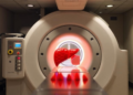 Large Randomized Trial Finds Proton Therapy Offers No Survival Advantage in Advanced Liver Cancer