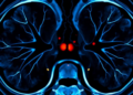 PET Imaging May Spare Patients Risky Drug Withdrawal Before Adrenal Vein Test