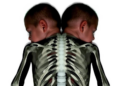 Rare Shoulder Birth Defect Linked to Twin Fractures Once Suspected as Abuse