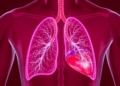 The Hidden Heart-Lung Link That Decides Who Survives ARDS