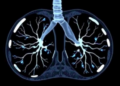 AI Reads CT Scans to Predict Hidden Lung Cancer Spread Before Surgery