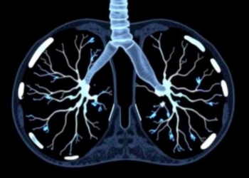 AI Reads CT Scans to Predict Hidden Lung Cancer Spread Before Surgery