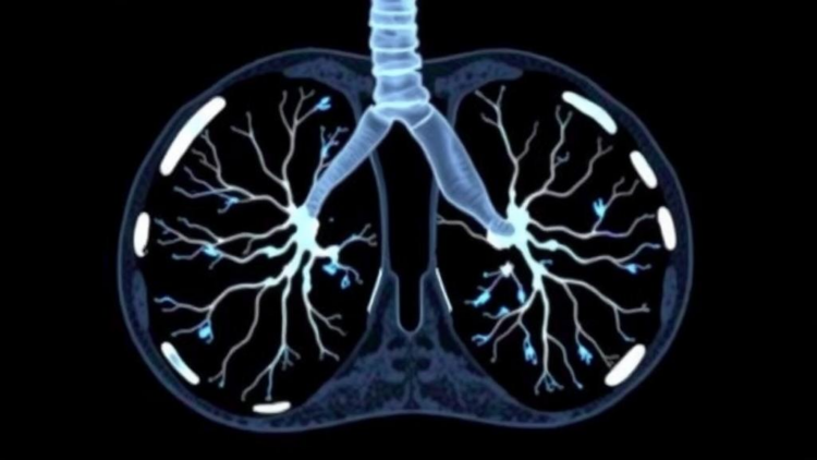 AI Reads CT Scans to Predict Hidden Lung Cancer Spread Before Surgery