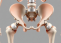 Virtual Muscles and a Clay-Fleshed Skeleton Teach Surgeons How Hard Is Too Hard in Hip Replacement